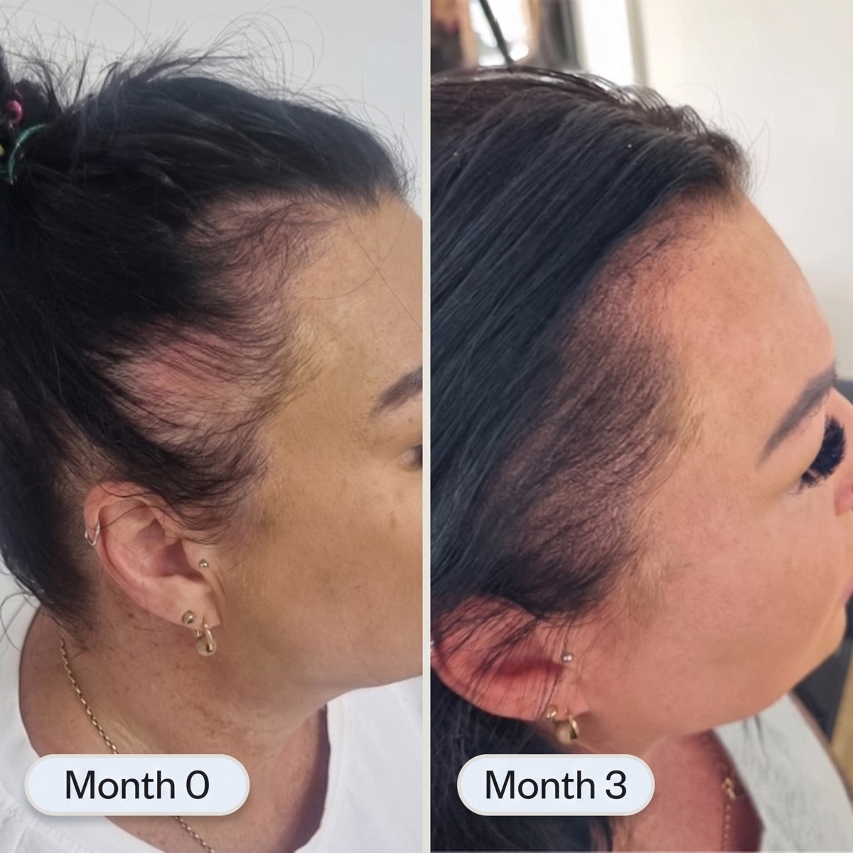 Before and after: her temples and hairline