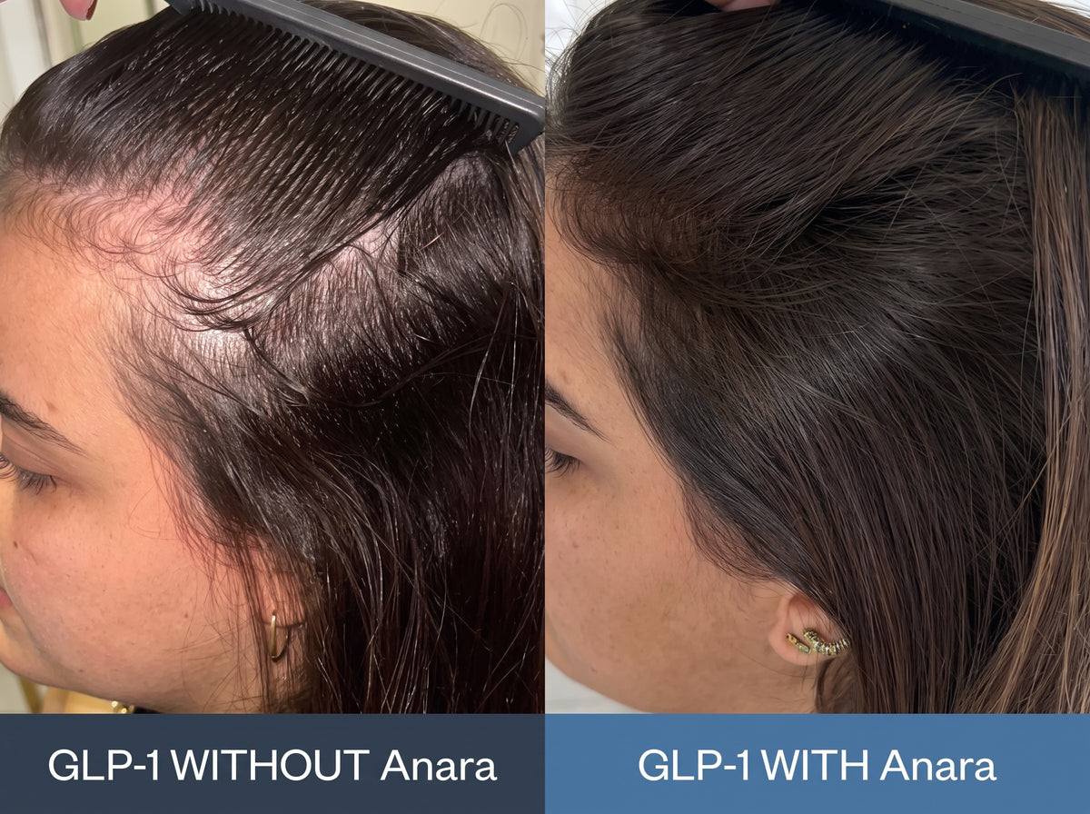 Side by side: the same woman’s hairline, thin and see-through at the temple with a comb lifting the hair, labeled GLP-1 without Anara; then full and dense at the same spot, labeled GLP-1 with Anara.