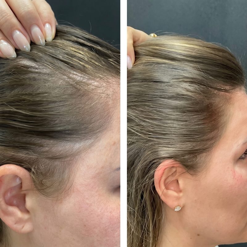 Amanda T.&rsquo;s before-and-after hairline photos