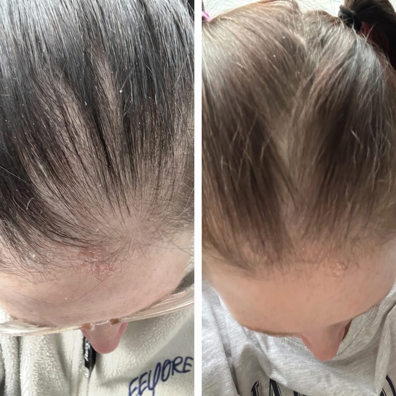 Angela F.&rsquo;s before-and-after part-line photos